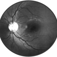 Figura 3. RFG con defecto de pantalla por hemorragia prerretinal foveal.
