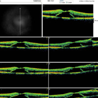 Figura 10. OCT macular OD, EM 656 μm se mantiene estable con respecto de la evolución anterior.